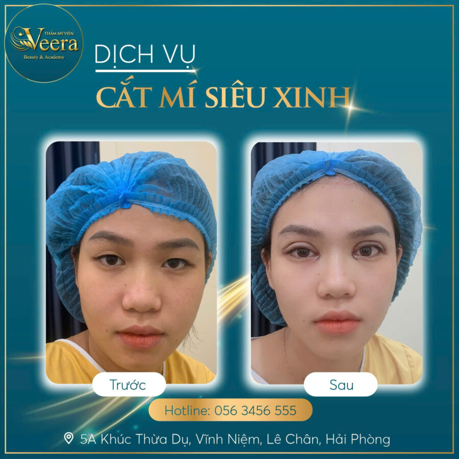 Cắt mí siêu xinh